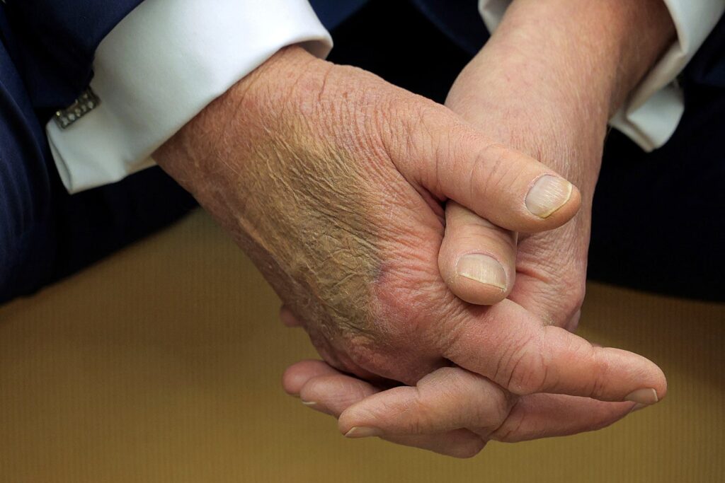 President Donald Trump's Hands